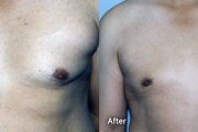 Male Breast Reduction Danville