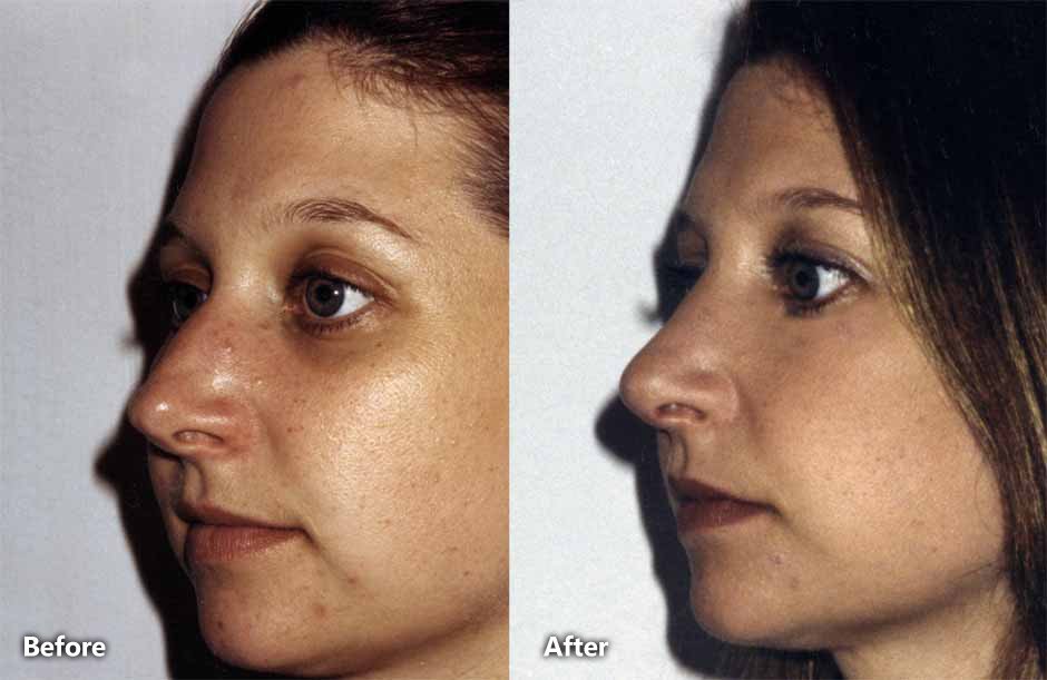 Rhinoplasty for Danville Patients to Improve Breathing