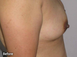 Breast Augmentation Patient 25967 Before Photo # 3