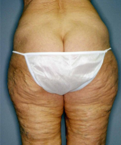 Body Contouring After Large Weight Loss Patient 64560 Before Photo # 1