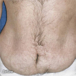 Body Contouring After Large Weight Loss Patient 33439 Before Photo # 1