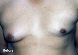 For Men Procedures Patient 81434 Before Photo # 1