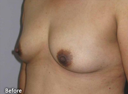 Breast Augmentation Patient 25967 Before Photo # 5