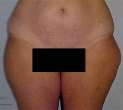 Liposuction Patient 34370 Before Photo # 1