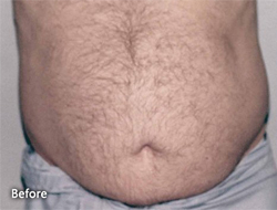 Tummy Tucks (Abdominoplasty) Patient 58162 Before Photo # 1
