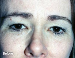 Forehead Lift Patient 35100 Before Photo # 1