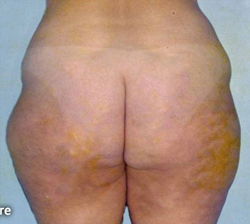 Liposuction Patient 34370 Before Photo # 3