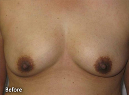 Breast Augmentation Patient 25967 Before Photo # 1