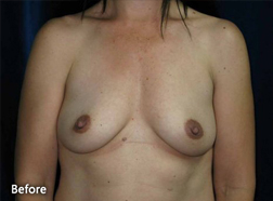 Breast Augmentation Patient 23582 Before Photo # 1