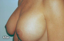Breast Augmentation Patient 43313 After Photo # 2