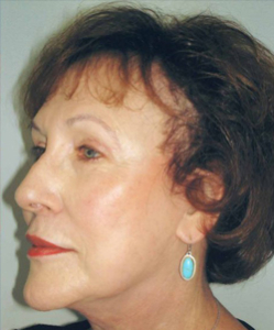 Forehead Lift Patient 93696 After Photo # 2