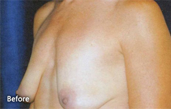 Breast Augmentation Patient 43313 Before Photo # 1