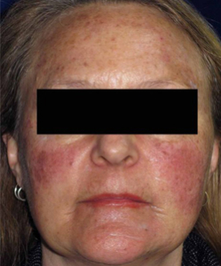 Laser Skin Rejuvenation Patient 60299 Before Photo # 1