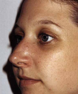 Nose Surgery Patient 37396 Before Photo # 1