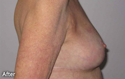 Breast Reduction Patient 96613 After Photo # 2