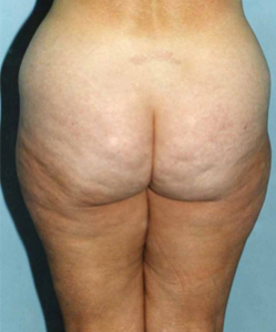 Liposuction Patient 37150 Before Photo # 1