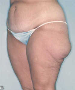 Body Contouring After Large Weight Loss Patient 87753 Before Photo # 1