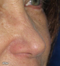 Nose Surgery Patient 80439 After Photo # 2