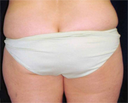 Liposuction Patient 61922 Before Photo # 1