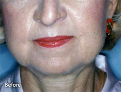 Chin Implants & Facial Liposuction Patient 13786 Before Photo # 1