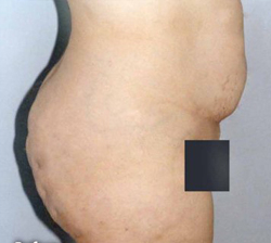 Liposuction Patient 34370 Before Photo # 5