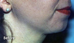 Chin Implants & Facial Liposuction Patient 38078 Before Photo # 1