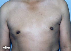 For Men Procedures Patient 81434 After Photo # 2