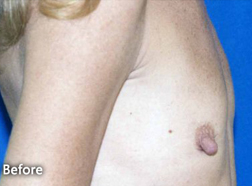 Breast Augmentation Patient 47293 Before Photo # 1