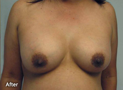 Breast Augmentation Patient 25967 After Photo # 2