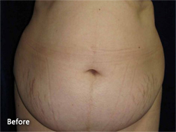 Tummy Tucks (Abdominoplasty) Patient 79931 Before Photo # 3