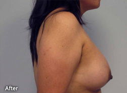 Breast Augmentation Patient 25967 After Photo # 4