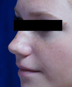 Nose Surgery Patient 27467 Before Photo # 1