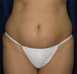 Liposuction Patient 58006 Before Photo # 1