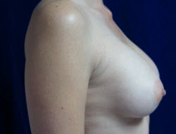 Breast Augmentation Patient 68938 After Photo # 10