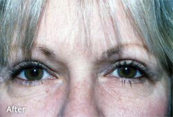 Eyelid Surgery Patient 17912 After Photo # 2