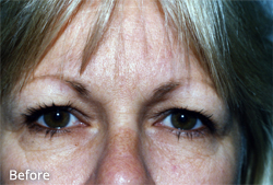 Eyelid Surgery Patient 17912 Before Photo # 1