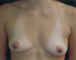 Breast Augmentation Patient 68938 Before Photo # 1