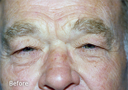 Eyelid Surgery Patient 72313 Before Photo # 1