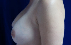 Breast Augmentation Patient 68938 After Photo # 6