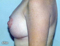 Breast Reshaping Patient 59582 After Photo # 2