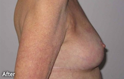 Breast Reshaping Patient 70856 After Photo # 2