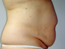 Tummy Tucks (Abdominoplasty) Patient 11305 Before Photo # 1