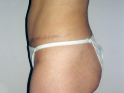 Tummy Tucks (Abdominoplasty) Patient 30368 After Photo # 6