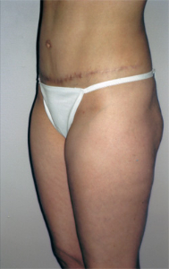 Tummy Tucks (Abdominoplasty) Patient 30368 After Photo # 2