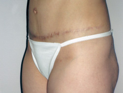 Tummy Tucks (Abdominoplasty) Patient 63474 After Photo # 4