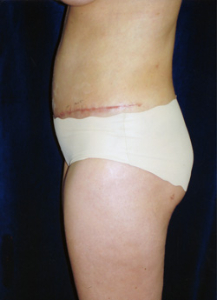 Tummy Tucks (Abdominoplasty) Patient 25214 Before Photo # 1