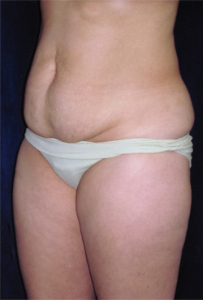 Tummy Tucks (Abdominoplasty) Patient 63474 Before Photo # 1