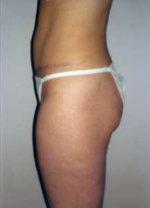 Tummy Tucks (Abdominoplasty) Patient 25214 After Photo # 2