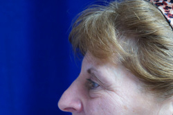 Eyelid Surgery Patient 62751 Before Photo # 3