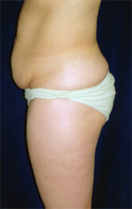 Tummy Tucks (Abdominoplasty) Patient 30368 Before Photo # 1